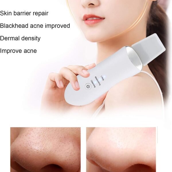 جهاز تقشير بالموجات فوق الصوتية